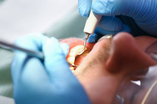 Best Broken or Chipped Tooth Repair in Van Buren, MO